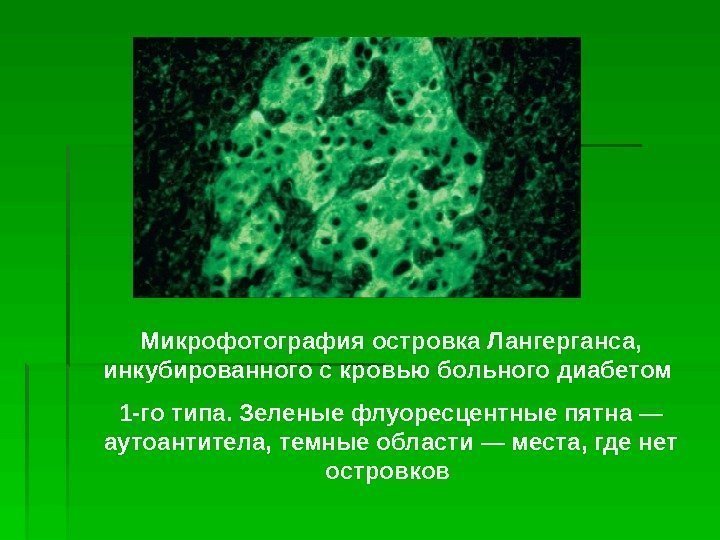 Микрофотография островка Лангерганса,  инкубированного с кровью больного диабетом 1 -го типа. Зеленые флуоресцентные