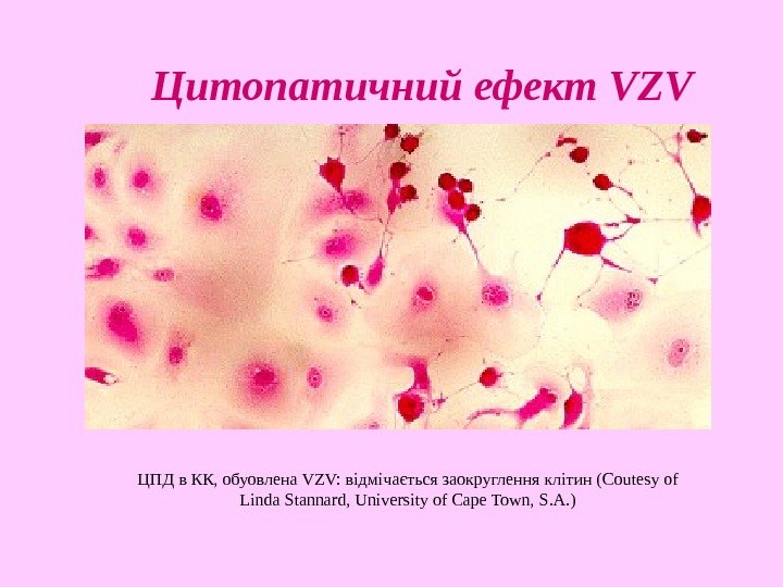 ЦПД в КК, обуовлена VZV:  відмічається заокруглення клітин (Coutesy of Linda Stannard, University