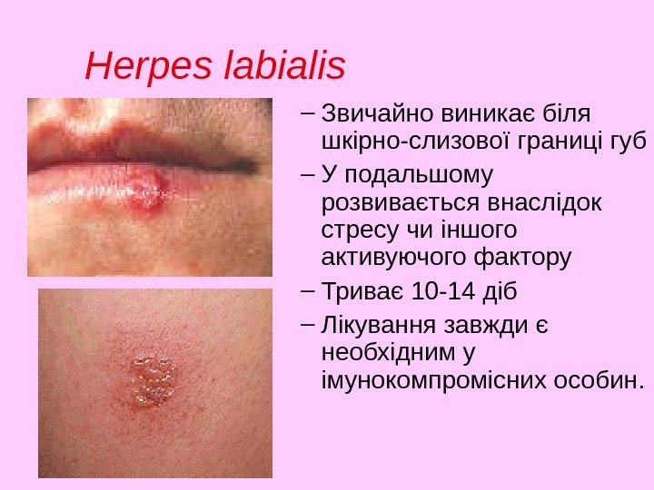 Herpes labialis – Звичайно виникає біля шкірно-слизової границі губ – У подальшому розвивається внаслідок