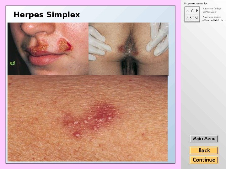 Herpes Simplex 