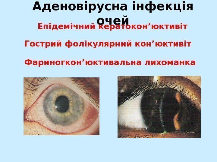   Аденовірусна інфекція очей Епідемічний кератокон ’ юктивіт Гострий фолікулярний кон ’ юктивіт