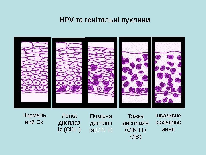   HPV та генітальні пухлини Нормаль ний Cx Легка дисплаз ія (CIN I)