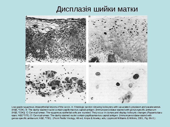   Low-grade squamous intraepithelial lesions of the cervix. A: Histologic section showing koilocytes