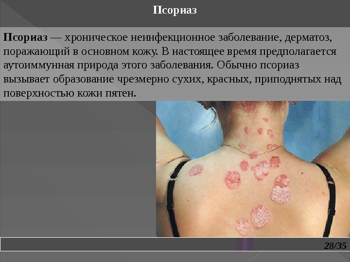 28/35 Псориаз — хроническое неинфекционное заболевание, дерматоз,  поражающий в основном кожу. В настоящее