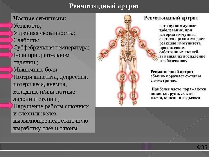 8/35 Ревматоидный артрит Частые симптомы:  Усталость; Утренняя скованность. ; Слабость;  Субфебрильная температура;