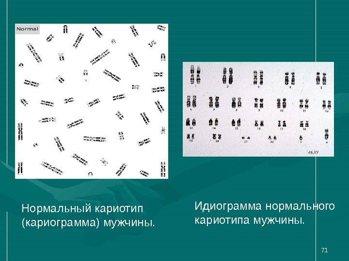 71 Нормальный кариотип (кариограмма) мужчины. Идиограмма нормального кариотипа мужчины.  