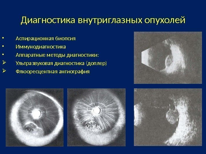 Диагностика внутриглазных опухолей • Аспирационная биопсия • Иммунодиагностика • Аппаратные методы диагностики:  Ультразвуковая