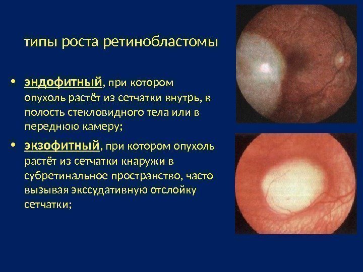  типы роста ретинобластомы • эндофитный , при котором опухоль растёт из сетчатки внутрь,