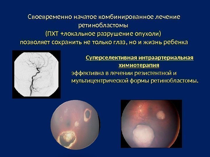 Своевременно начатое комбинированное лечение ретинобластомы (ПХТ +локальное разрушение опухоли) позволяет сохранить не только глаз,
