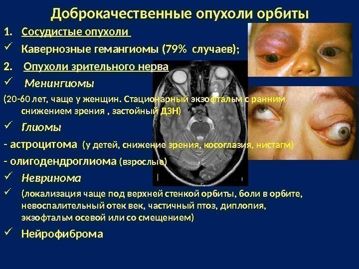 1. Сосудистые опухоли  Кавернозные гемангиомы (79 случаев); 2. Опухоли зрительного нерва  Менингиомы