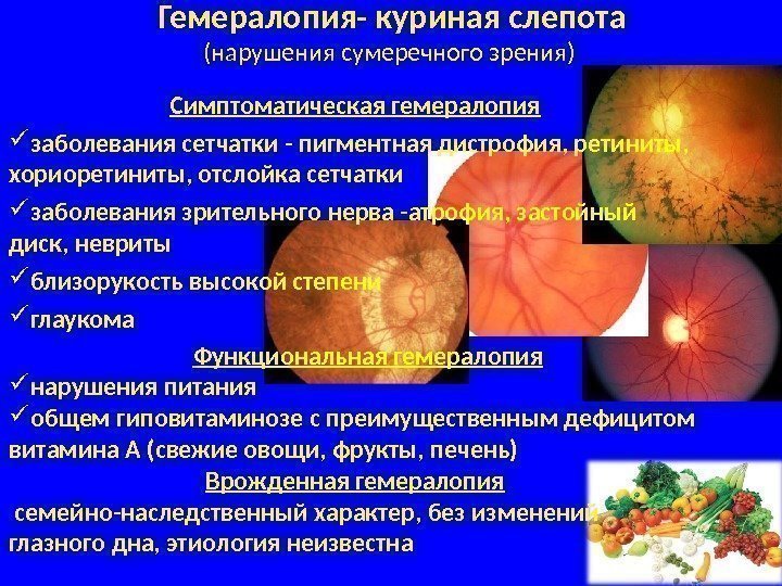 Гемералопия- куриная слепота (нарушения сумеречного зрения) Симптоматическая гемералопия заболевания сетчатки - пигментная дистрофия, ретиниты,