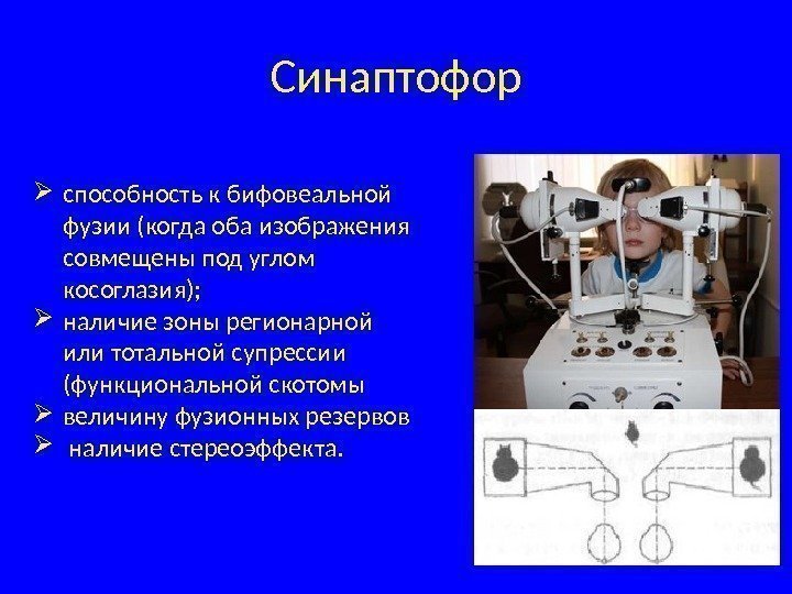 Синаптофор способность к бифовеальной фузии (когда оба изображения совмещены под углом косоглазия);  наличие