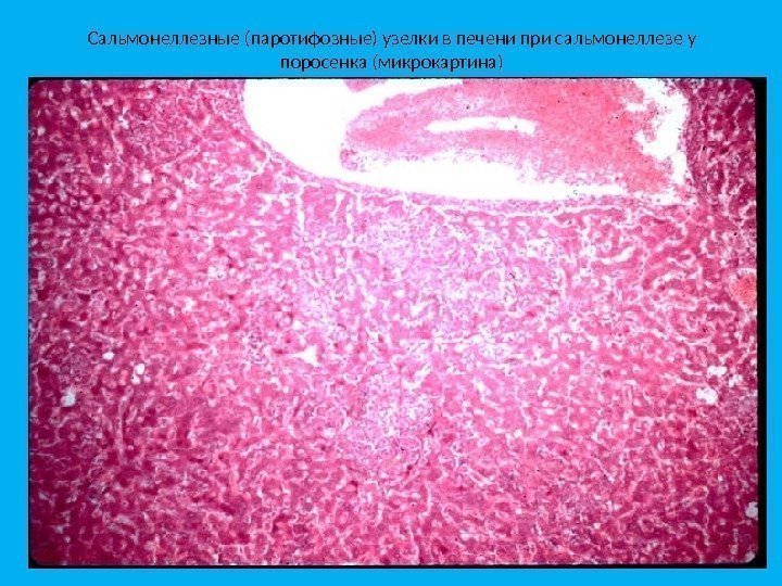 Сальмонеллезные (паротифозные) узелки в печени при сальмонеллезе у поросенка (микрокартина) 