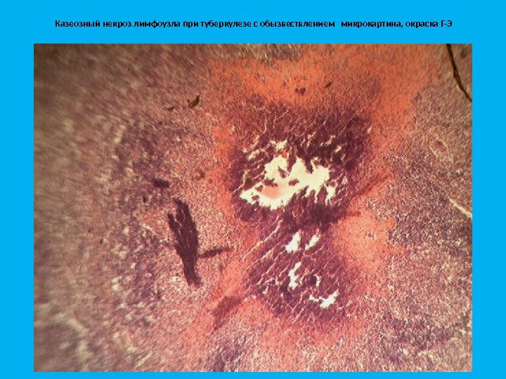 Казеозный некроз лимфоузла при туберкулезе с обызвествлением  микрокартина, окраска Г-Э 