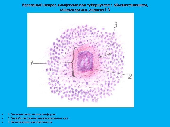 Казеозный некроз лимфоузла при туберкулезе с обызвествлением,  микрокартина, окраска Г-Э • 1. Зона