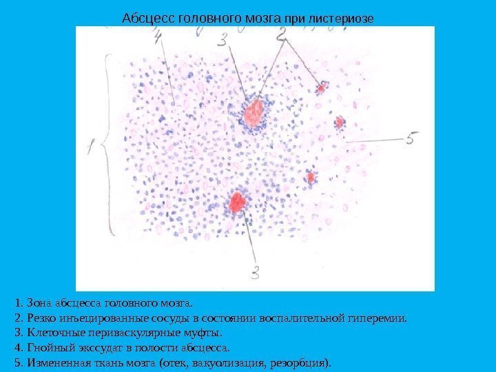 Абсцесс головного мозга при листериозе 1. Зонаабсцессаголовногомозга. 2. Резкоинъецированныесосудывсостояниивоспалительнойгиперемии. 3. Клеточныепериваскулярныемуфты. 4. Гнойныйэкссудатвполостиабсцесса. 5.