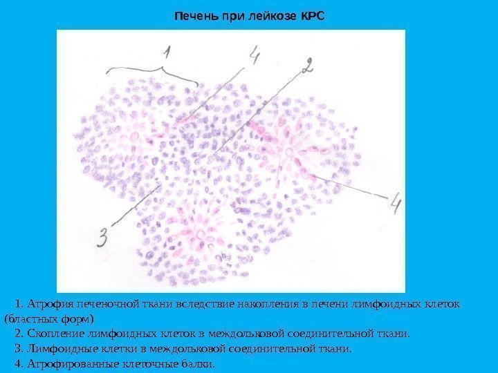 Печень при лейкозе КРС 1. Атрофия печеночной ткани вследствие накопления в печени лимфоидных клеток
