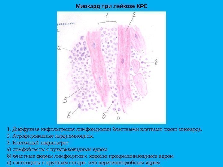 Миокард при лейкозе КРС 1. Диффузная инфильтрация лимфоидными бластными клетками ткани миокарда. 2. Атрофированные