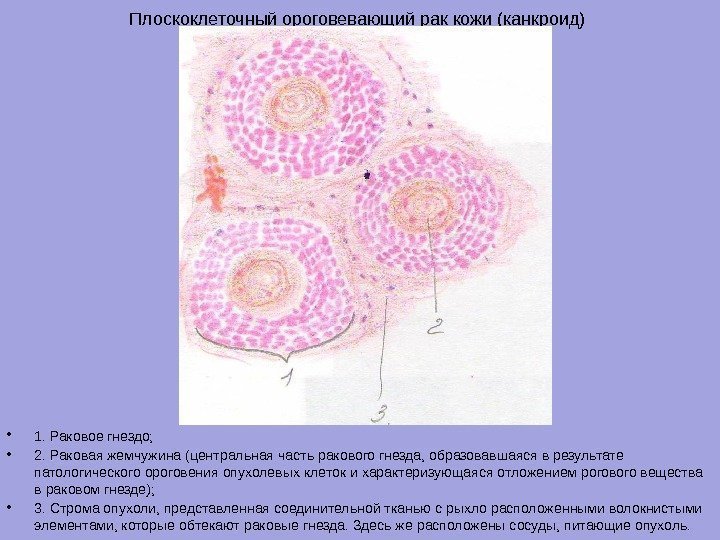 Плоскоклеточный ороговевающий рак кожи (канкроид)  • 1. Раковое гнездо;  • 2. Раковая