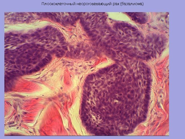 Плоскоклеточный неороговевающий рак (базалиома) 