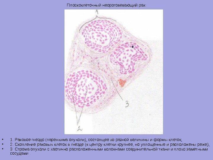 Плоскоклеточный неороговевающий рак  • 1. Раковое гнездо (паренхима опухоли), состоящее из разной величины
