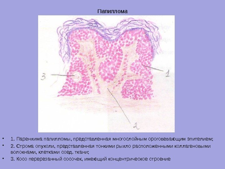 Папиллома • 1. Паренхима папилломы, представленная многослойным ороговевающим эпителием;  • 2. Строма опухоли,