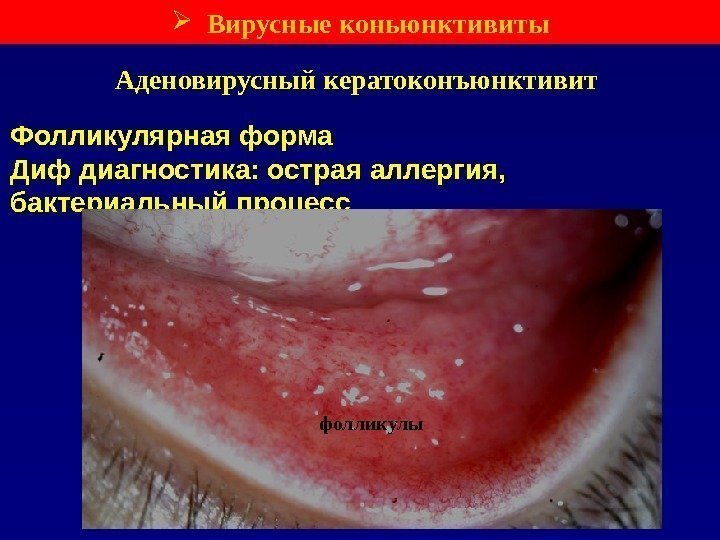 Фолликулярная форма Диф диагностика: острая аллергия,  бактериальный процесс Аденовирусный кератоконъюнктивит фолликулы Вирусные коньюнктивиты