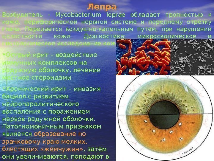 Лепра Возбудитель - Mycobacterium leprae  обладает тропностью к коже,  периферической нервной системе