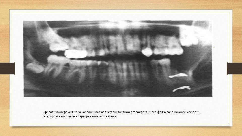 Ортопантомограмма того же больного после реплантации резецированного фрагмента нижней челюсти,  фиксированного двумя серебряными