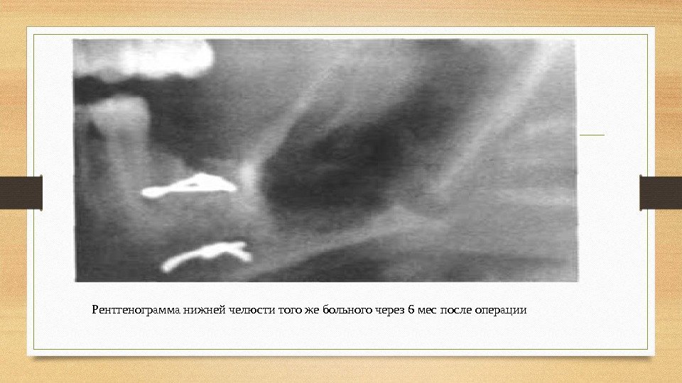 Рентгенограмма нижней челюс ти того же больного через 6 мес после опе рации 