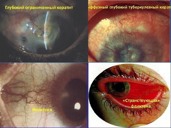 Диффузный глубокий туберкулезный кератит Глубокий ограниченный кератит Фликтена «Странствующая»  фликтена.  
