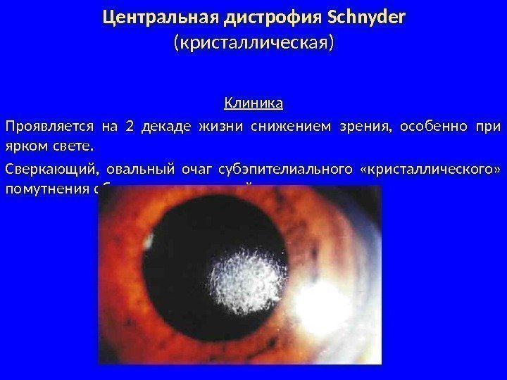 Центральная дистрофия Schnyder (кристаллическая) Клиника Проявляется на 2 декаде жизни снижением зрения,  особенно