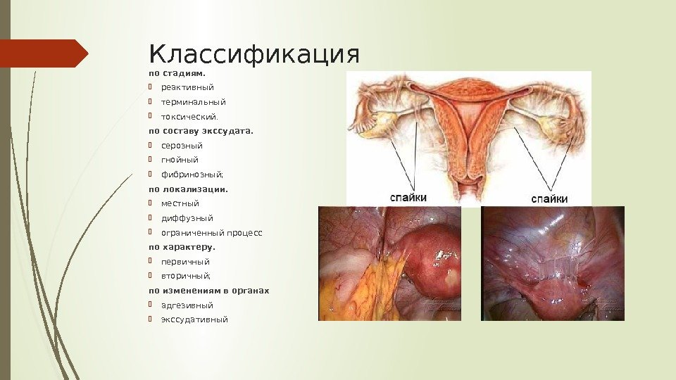 Классификация по стадиям. реактивный терминальный  токсический.  по составу экссудата. серозный гнойный 