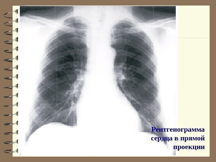   Рентгенограмма сердца в прямой проекции 