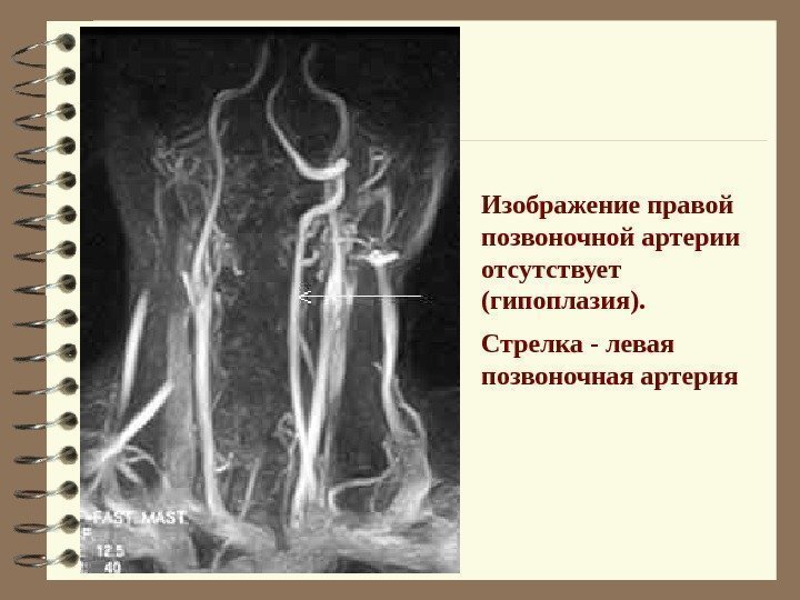   Изображение правой позвоночной артерии отсутствует (гипоплазия).  Стрелка - левая позвоночная артерия