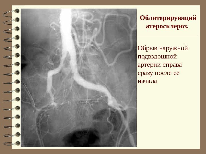   Облитерирующий атеросклероз.  Обрыв наружной подвздошной артерии справа сразу после её начала