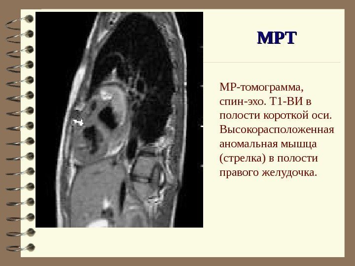   МР-томограмма,  спин-эхо. Т 1 -ВИ в полости короткой оси.  Высокорасположенная