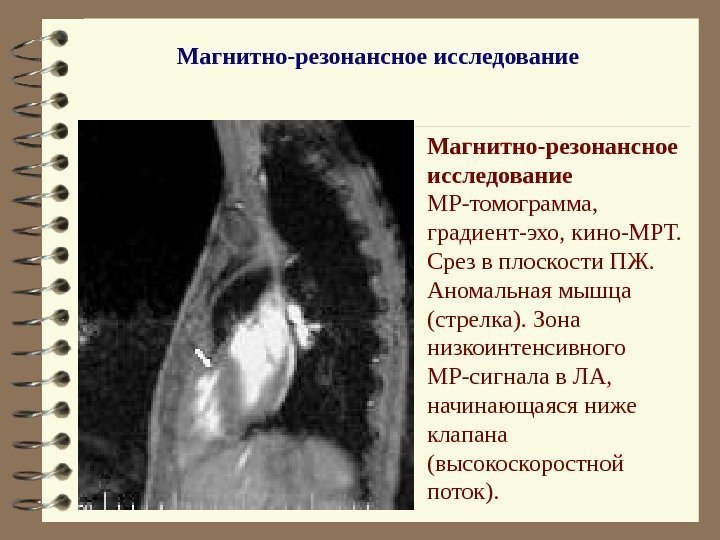   Магнитно-резонансное исследование МР-томограмма,  градиент-эхо, кино-МРТ.  Срез в плоскости ПЖ. 