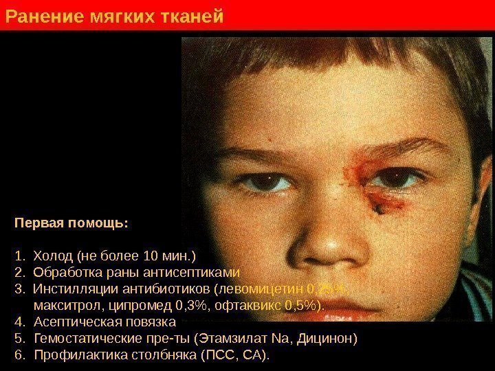   Ранение мягких тканей Первая помощь: 1. Холод (не более 10 мин. )