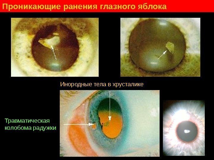   Проникающие ранения глазного яблока Инородные тела в хрусталике Травматическая колобома радужки 
