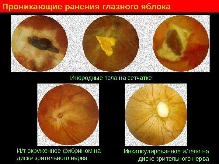   Проникающие ранения глазного яблока Инородные тела на сетчатке И / т окруженное