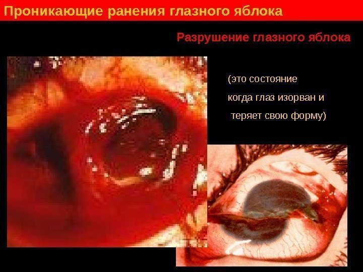   Проникающие ранения глазного яблока Разрушение глазного яблока (это состояние когда глаз изорван