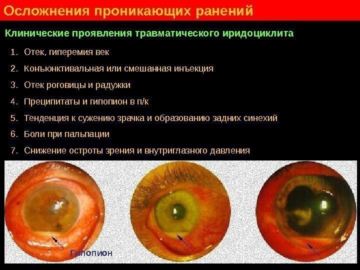   Осложнения проникающих ранений Клинические проявления травматического иридоциклита 1. Отек, гиперемия век 2.