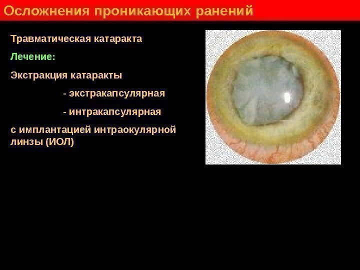   Осложнения проникающих ранений Травматическая катаракта Лечение: Экстракция катаракты    