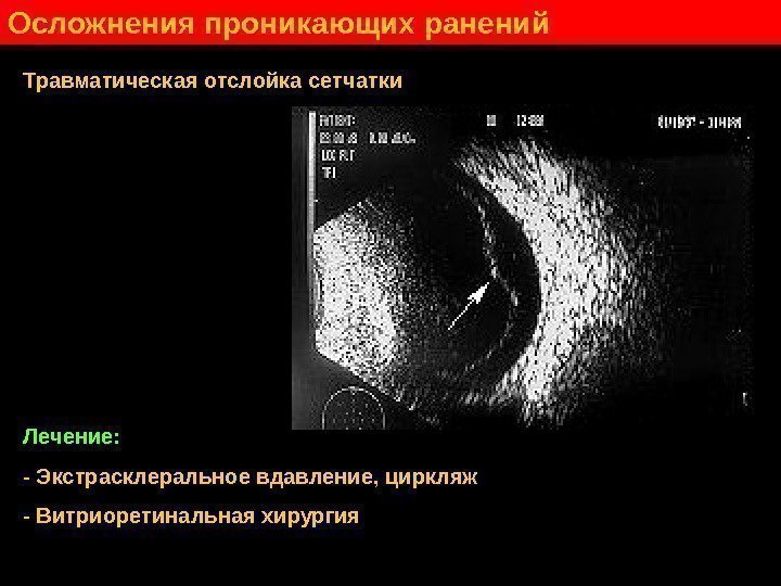   Осложнения проникающих ранений Травматическая отслойка сетчатки Лечение: - Экстрасклеральное вдавление, циркляж -