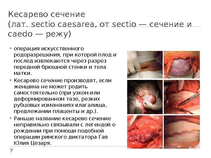 Кесарево сечение (лат. sectio caesarea, от sectio — сечение и caedo — режу) операция