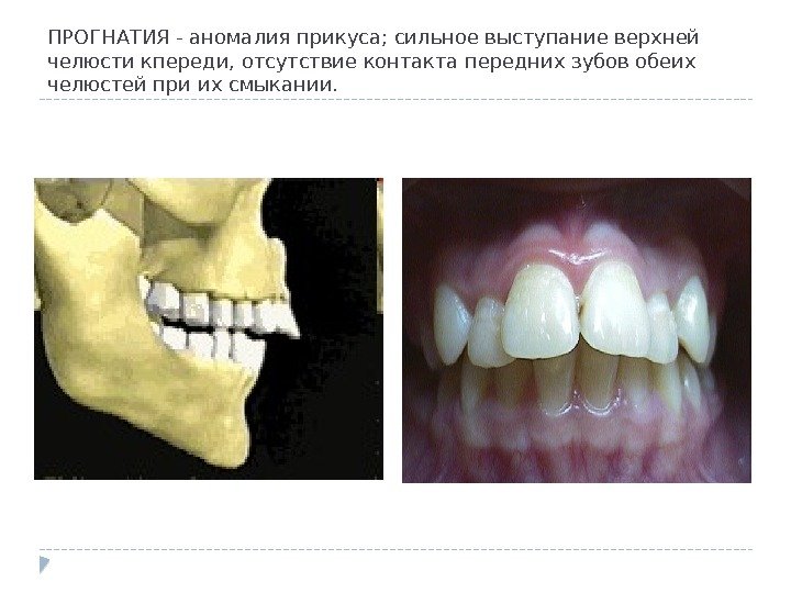 ПРОГНАТИЯ - аномалия прикуса; сильное выступание верхней челюсти кпереди, отсутствие контакта передних зубов обеих