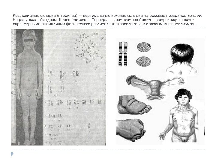 Крыловидные складки (птеригии) — вертикальные кожные складки на боковых поверхностях шеи. На рисунках -