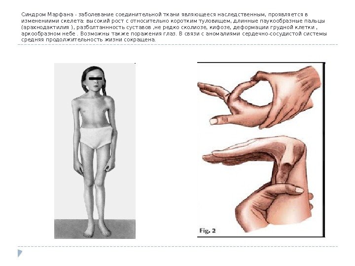 Синдром Марфана - заболевание соединительной ткани являющееся наследственным, проявляется в изменениими скелета: высокий рост