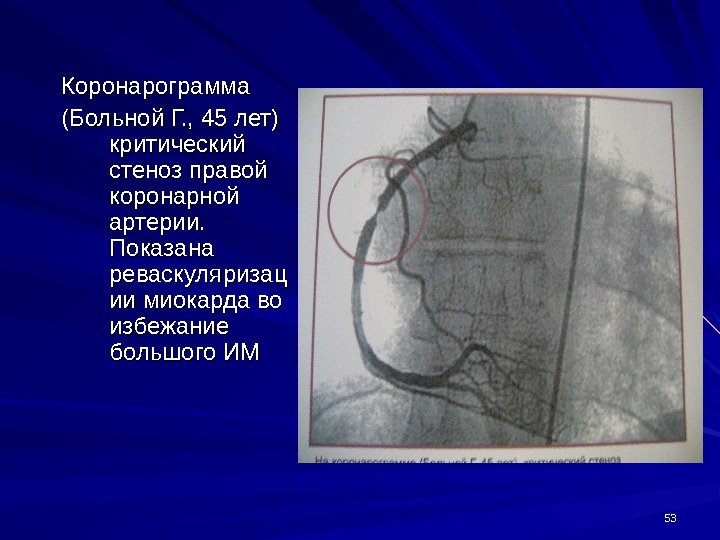 5353 Коронарограмма (Больной Г. , 45 лет) критический стеноз правой коронарной артерии.  Показана
